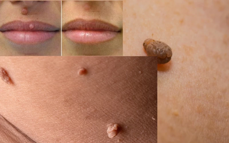 Optocenter | Optika Minus 50 - Odstranjevanje znamenj na koži 